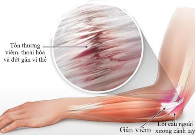 Hội Chứng Tennis Elbow Là Gì: Tổng Quan Từ A Đến Z Về Chấn Thương Khuỷu Tay