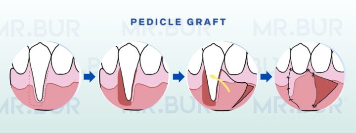 Hướng Dẫn Kỹ Thuật Chuyền Một Chính Xác Trong Bóng Chuyền Đỉnh Cao