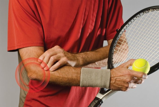 Hội Chứng Tennis Elbow Là Gì: Tổng Quan Từ A Đến Z Về Chấn Thương Khuỷu Tay