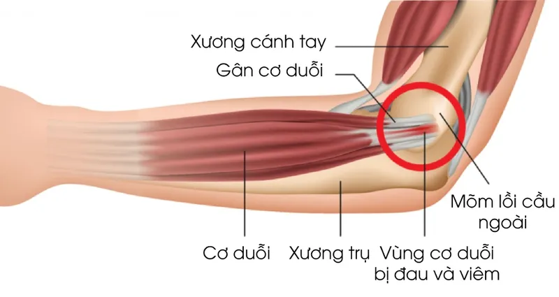 Hình ảnh minh họa vị trí viêm gân khuỷu tay ngoài, liên quan đến hội chứng tennis elbow là gì.