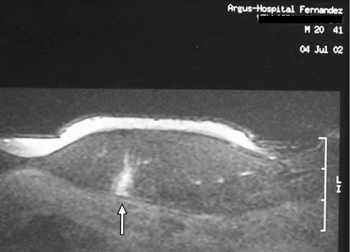 Chấn thương cơ thẳng bụng ở vận động viên tennis