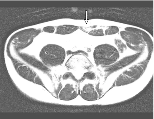 Hình ảnh T1 MR axial của vận động viên tennis chuyên nghiệp nam 27 tuổi bị đau cơ RA trong khi giao bóng; tiền sử lâm sàng cho thấy bốn lần chấn thương cơ RA.